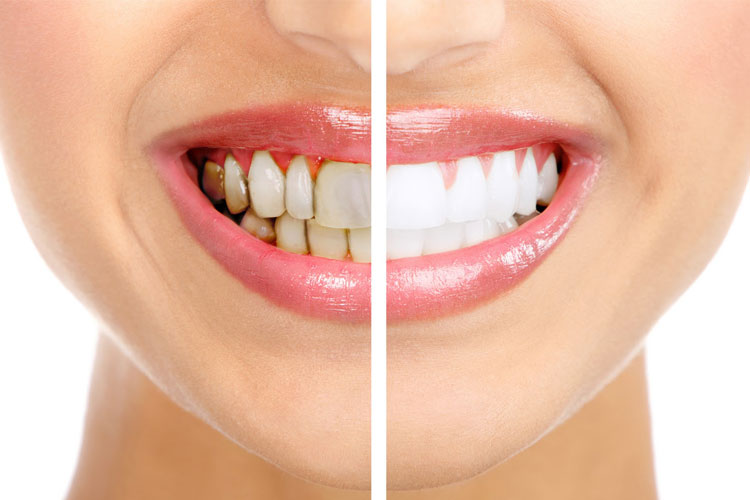 Зубной камень: причины возникновения и профилактика